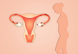 Endometriose en Lichen sclerosus bij DES-dochters